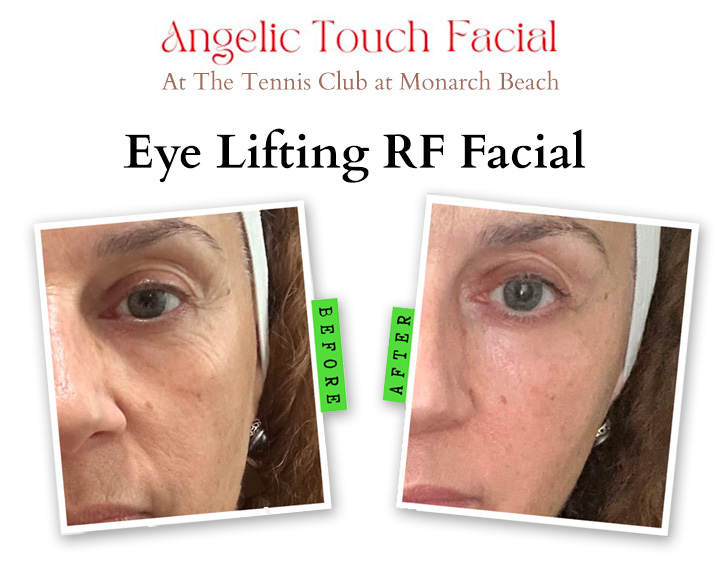 Eye Lifting RF Facial